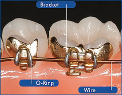 iBraces